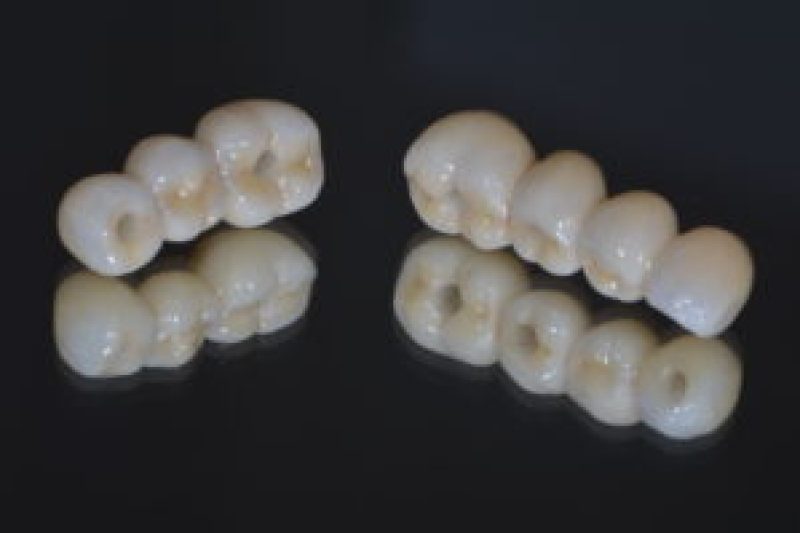 Dental Implants Cincinnati Prosthodontics